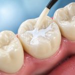 how long do dental sealants last maintenance care tips